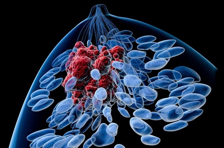 Colloidal Silver and Breast Cancer Cells Tumor