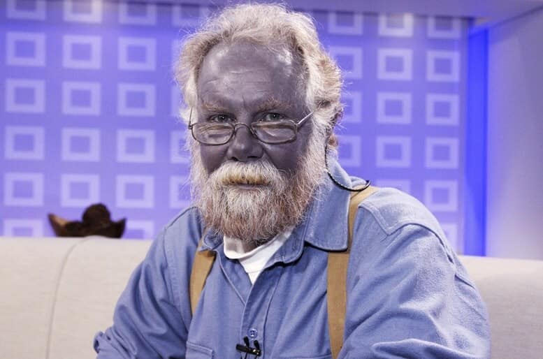 Colloidal Silver and Argyria